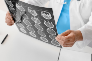 Specijalistički neurološki pregled - Poliklinika Arcadia