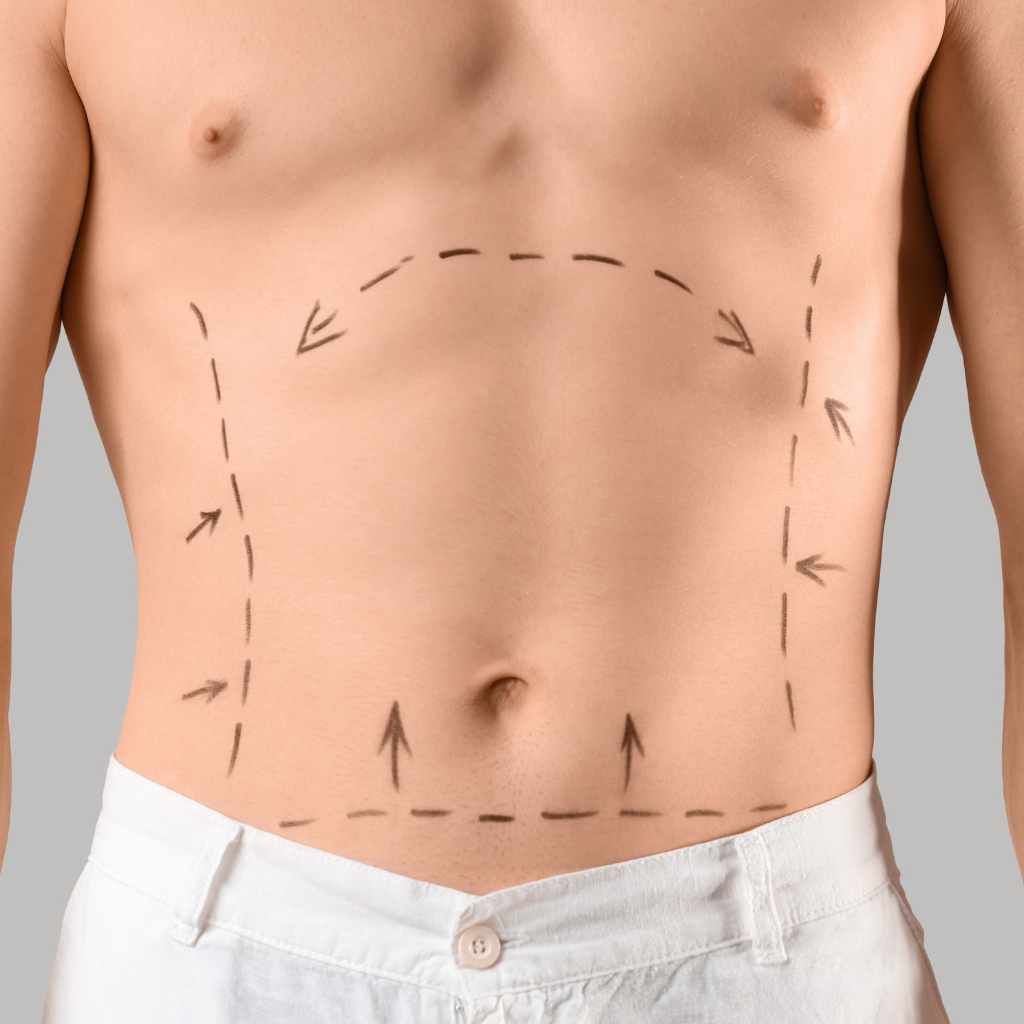 Abdominoplastika - Poliklinika Arcadia