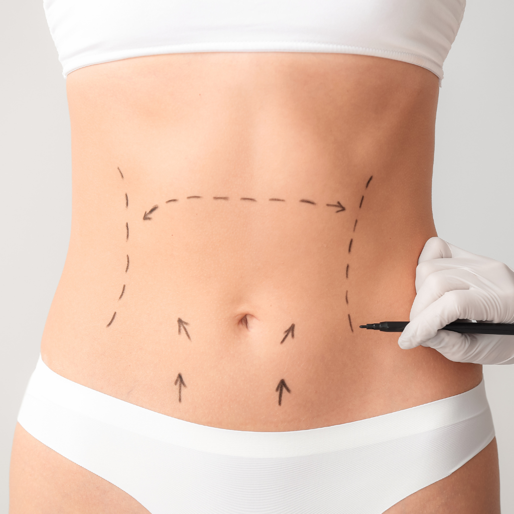 Mini abdominoplastika - Poliklinika Arcadia